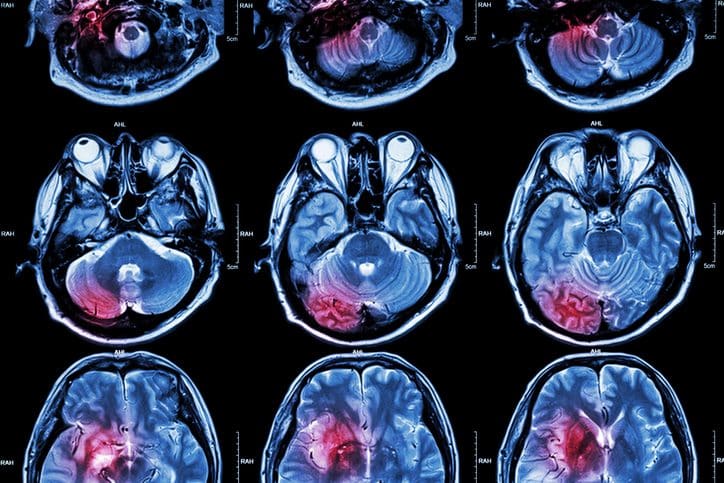 Película IRM ( Imágenes por resonancia magnética ) del cerebro ( apoplejía , tumor cerebral , infarto cerebral , hemorragia intracerebral ) ( Medicina , Asistencia sanitaria , Trasfondo científico ) ( Corte transversal del cerebro )